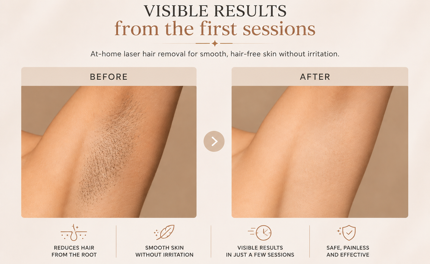 TaraLuxe™ IPL
